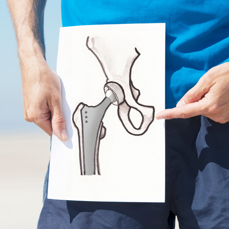 Hip Replacement Surgery